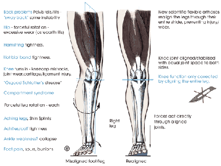 orthotics