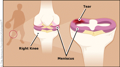 Knee-injury.gif