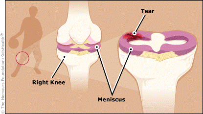 Knee injury